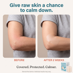 Calluve Flareguard™ — Cut-to-Fit Eczema Flare Patch
