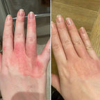 Calluve Flareguard™ — Cut-to-Fit Eczema Flare Patch