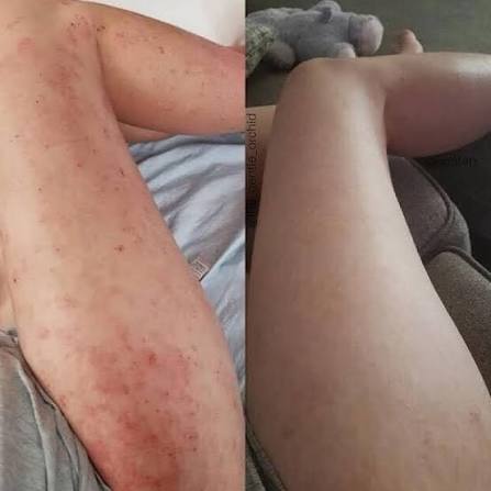 Calluve Flareguard™ — Cut-to-Fit Eczema Flare Patch