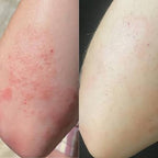 Calluve Flareguard™ — Cut-to-Fit Eczema Flare Patch